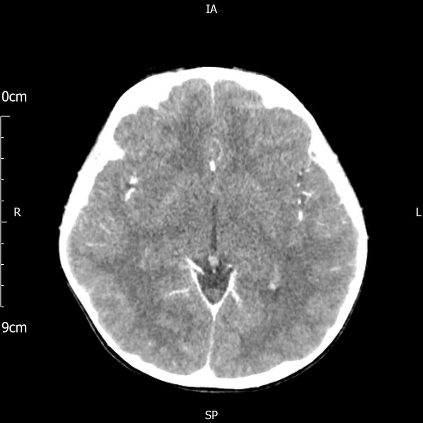 Cavernous sinus thrombosis (Radiopaedia 79414-92510 Axial Brain 100).jpg