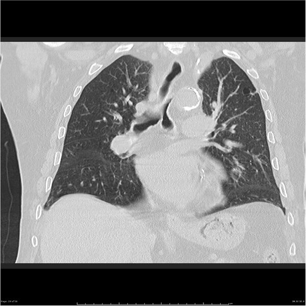 File:Cavitating left lower lobe lesion - squamous cell lung cancer (Radiopaedia 27749-28176 Coronal lung window 29).jpg