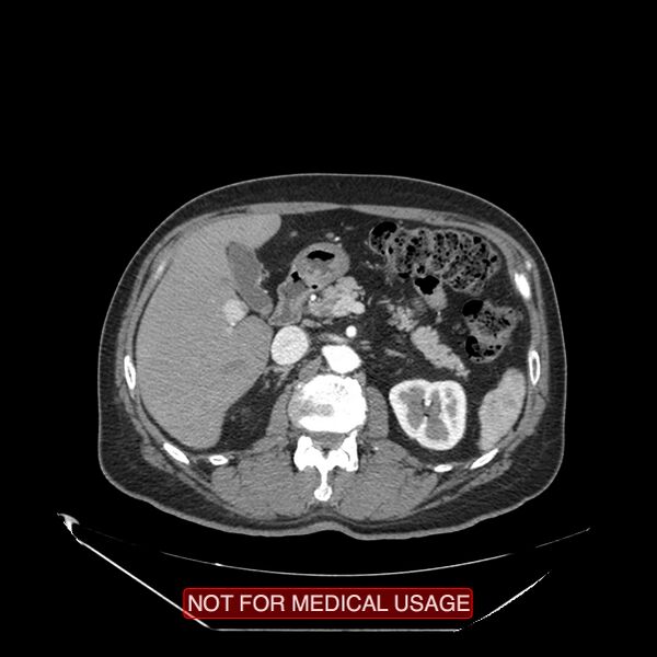 File:Celiac trunk variant anatomy - gastrohepatic trunk and splenic artery (Radiopaedia 38815-40995 A 35).jpg