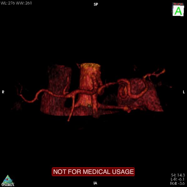 File:Celiac trunk variant anatomy - gastrohepatic trunk and splenic artery (Radiopaedia 38815-40995 B 7).jpg