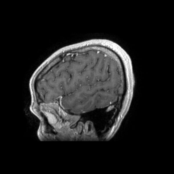 File:Central neurocytoma (Radiopaedia 67618-77021 Sagittal T1 C+ 25).jpg