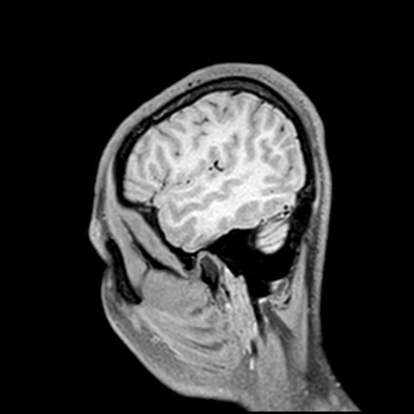File:Central neurocytoma (Radiopaedia 79320-92380 Sagittal T1 216).jpg