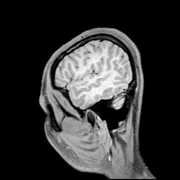 File:Central neurocytoma (Radiopaedia 79320-92380 Sagittal T1 217).jpg