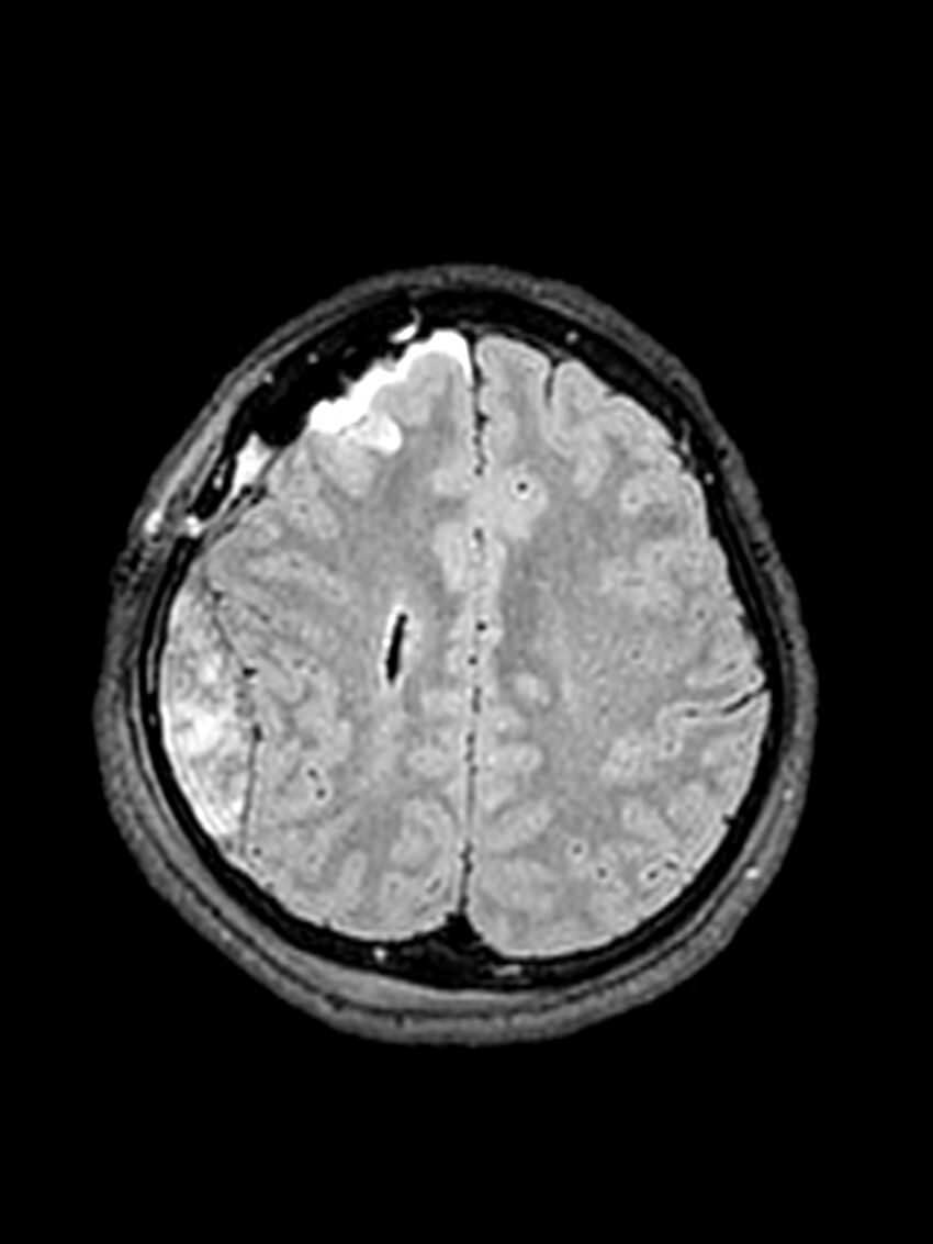Central neurocytoma (Radiopaedia 79320-92381 Axial FLAIR 56).jpg
