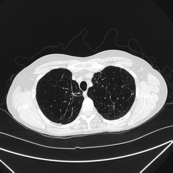 File:Centrilobular pulmonary emphysema (Radiopaedia 24495-24789 Axial lung window 18).jpg