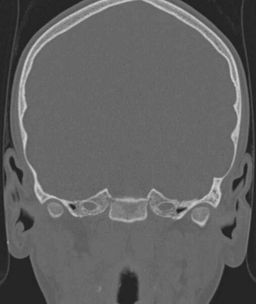File:Cerebellar abscess (Radiopaedia 73727-84527 Coronal bone window 85).jpg