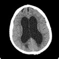 Cerebellar abscess secondary to mastoiditis (Radiopaedia 26284-26412 Axial non-contrast 98).jpg