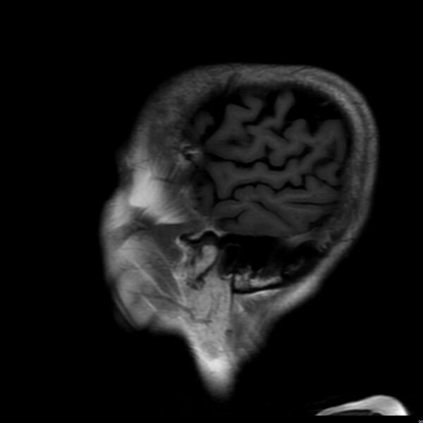 File:Cerebellar ataxia with neuropathy and vestibular areflexia syndrome (CANVAS) (Radiopaedia 74283-85159 Sagittal FLAIR 19).jpg