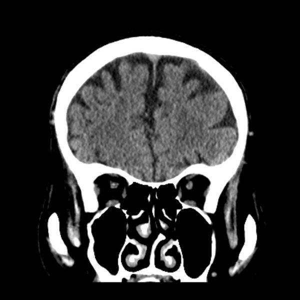 File:Cerebellar hemorrhage (Radiopaedia 27193-27359 Coronal non-contrast 16).jpg