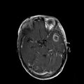 Cerebral abscess post cardiac surgery (Radiopaedia 27244-27420 Axial T1 C+ 6).jpg