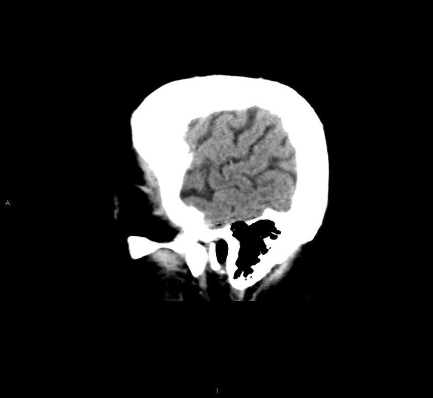 Cerebral amyloid angiopathy-associated lobar intracerebral hemorrhage (Radiopaedia 58376-65511 C 7).jpg