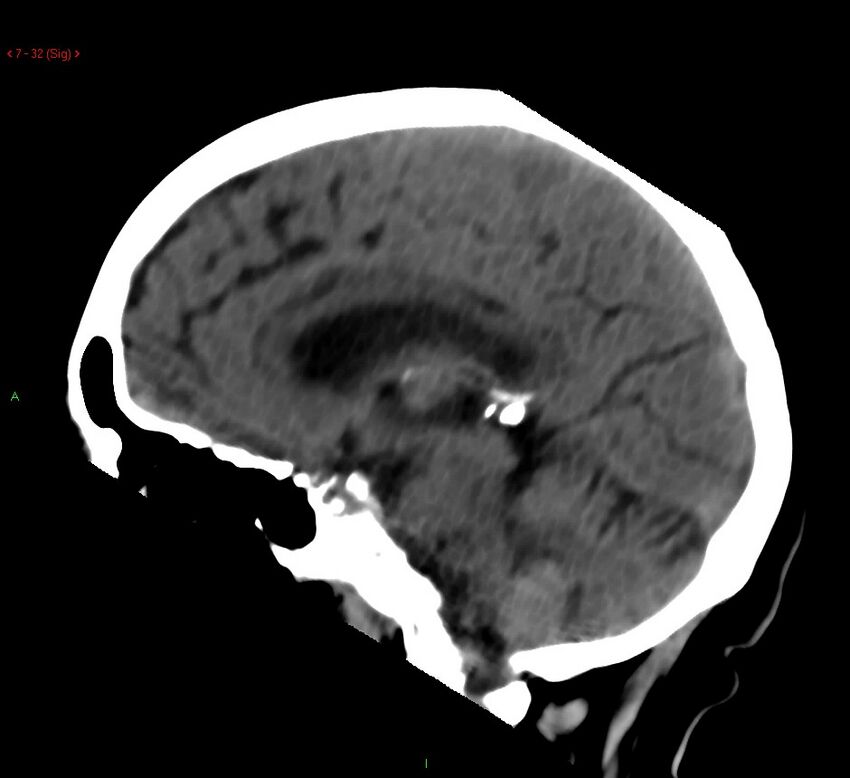 Cerebral amyloid angiopathy-associated lobar intracerebral hemorrhage (Radiopaedia 58378-65518 C 32).jpg