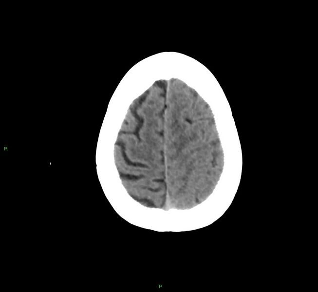 File:Cerebral amyloid angiopathy-associated lobar intracerebral hemorrhage (Radiopaedia 58754-65975 Axial non-contrast 17).jpg