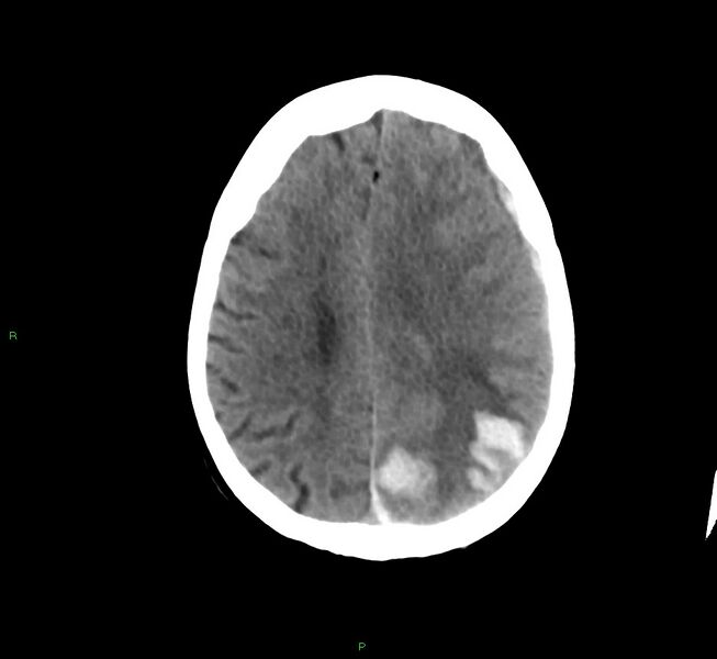 File:Cerebral amyloid angiopathy-associated lobar intracerebral hemorrhage (Radiopaedia 58754-65975 Axial non-contrast 25).jpg