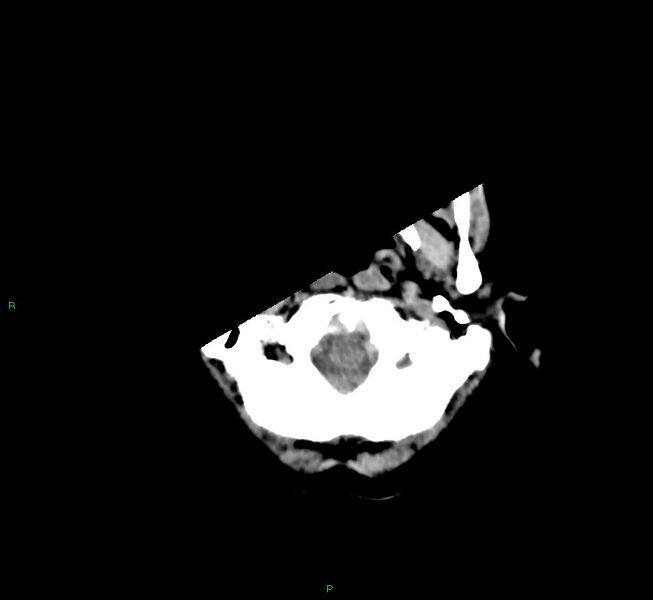 File:Cerebral amyloid angiopathy-associated lobar intracerebral hemorrhage (Radiopaedia 58754-65975 Axial non-contrast 54).jpg