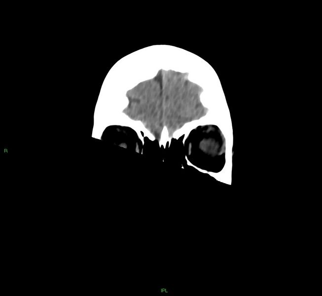 File:Cerebral amyloid angiopathy-associated lobar intracerebral hemorrhage (Radiopaedia 58754-65975 Coronal non-contrast 53).jpg