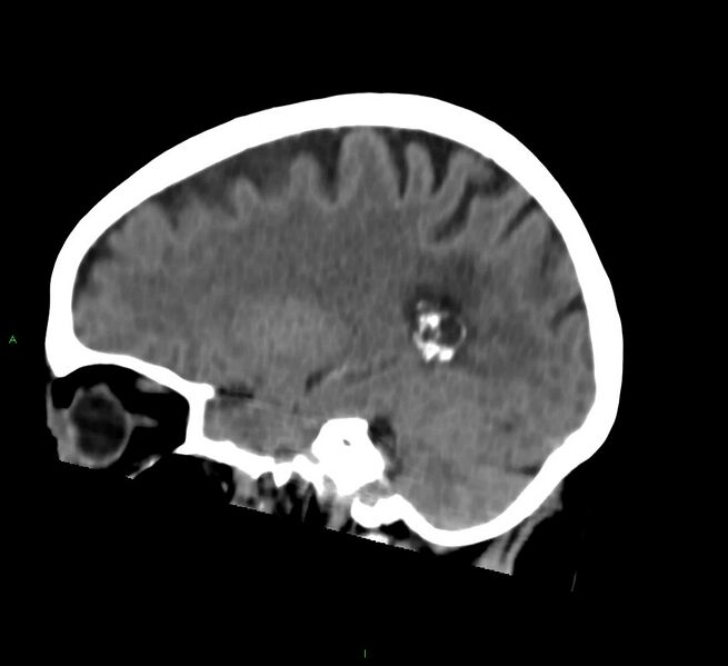 File:Cerebral amyloid angiopathy-associated lobar intracerebral hemorrhage (Radiopaedia 58757-65978 C 19).jpg