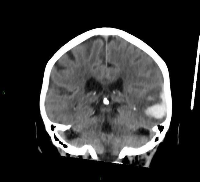 File:Cerebral amyloid angiopathy-associated lobar intracerebral hemorrhage (Radiopaedia 58757-65978 Coronal non-contrast 28).jpg