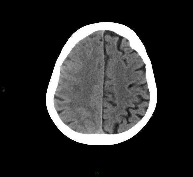 File:Cerebral amyloid angiopathy-associated lobar intracerebral hemorrhage (Radiopaedia 58758-65980 Axial non-contrast 14).jpg