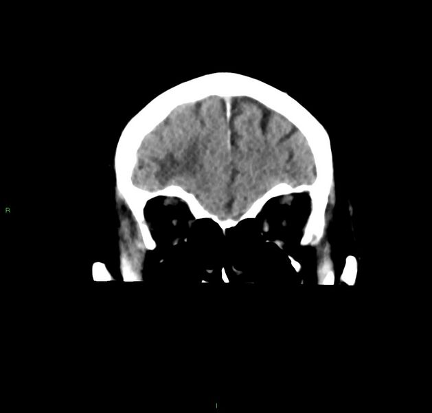 File:Cerebral amyloid angiopathy-associated lobar intracerebral hemorrhage (Radiopaedia 59356-66716 Coronal non-contrast 52).jpg