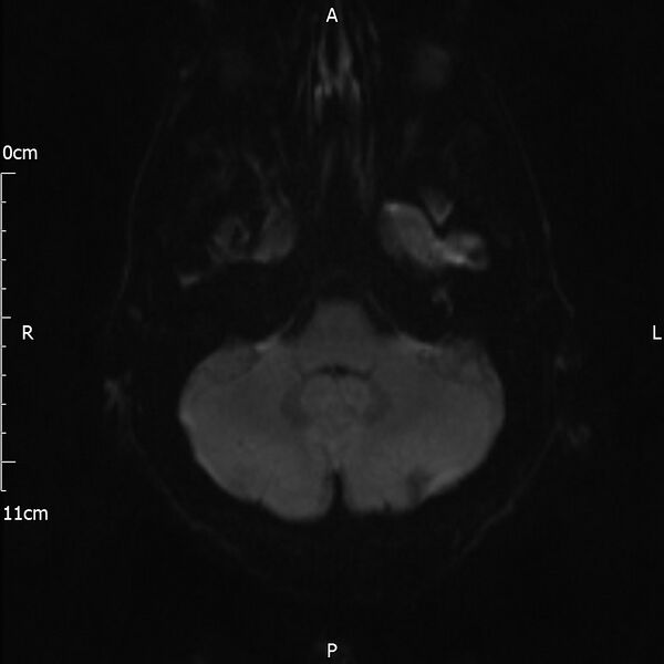 File:Cerebral amyloid angiopathy related inflammation (Radiopaedia 72772-83415 Axial DWI 29).jpg