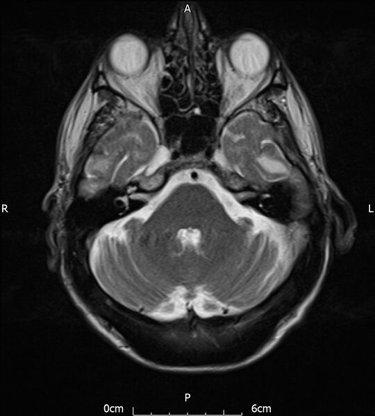 File:Cerebral amyloid angiopathy related inflammation (Radiopaedia 72772-83415 Axial T2 7).jpg