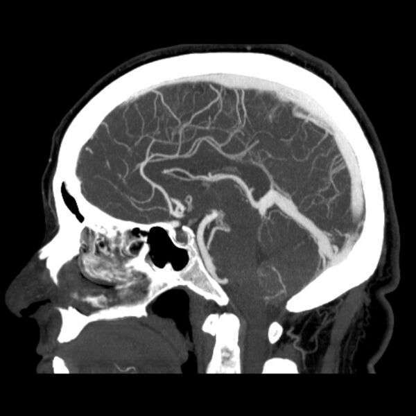 File:Cerebral arteriovenous malformation (Radiopaedia 43729-47189 D 24).jpg