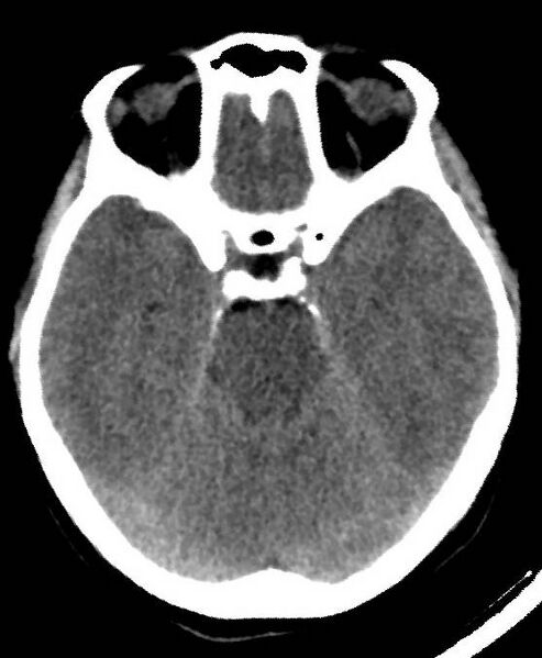File:Cerebral edema due to severe hyponatremia (Radiopaedia 89826-106937 Axial non-contrast 31).jpg