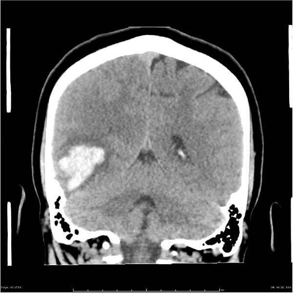 File:Cerebral hemorrhage secondary to arteriovenous malformation (Radiopaedia 33497-34561 Coronal non-contrast 36).jpg