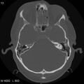 Cerebral hemorrhagic contusion with subdural and subarachnoid hemorrhage (Radiopaedia 10680-11146 Axial bone window 11).jpg