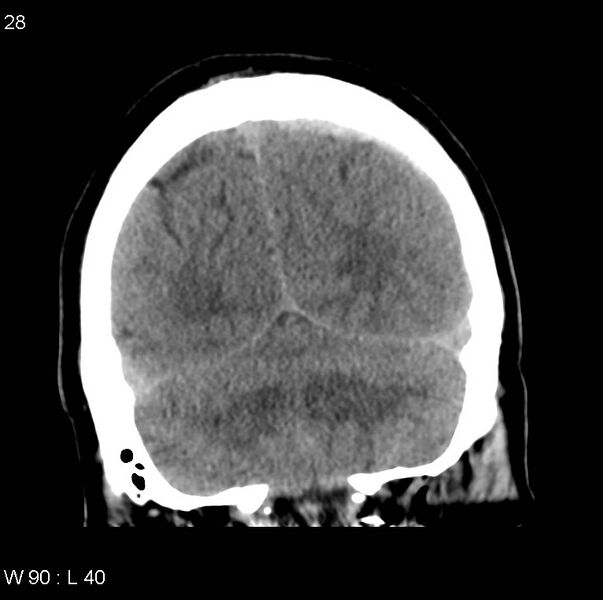 File:Cerebral hemorrhagic contusion with subdural and subarachnoid hemorrhage (Radiopaedia 10680-11146 Coronal non-contrast 15).jpg