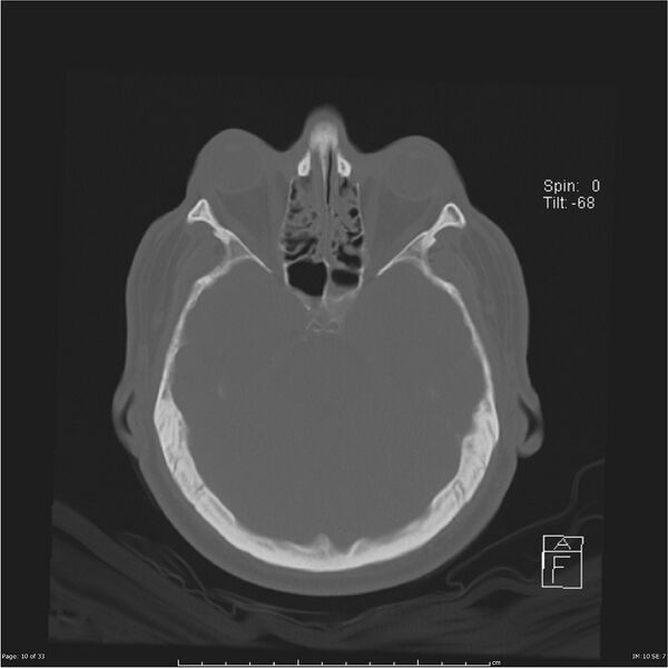 File:Cerebral hemorrhagic contusions and cervical spine fractures (Radiopaedia 32865-33841 Axial bone window 10).jpg