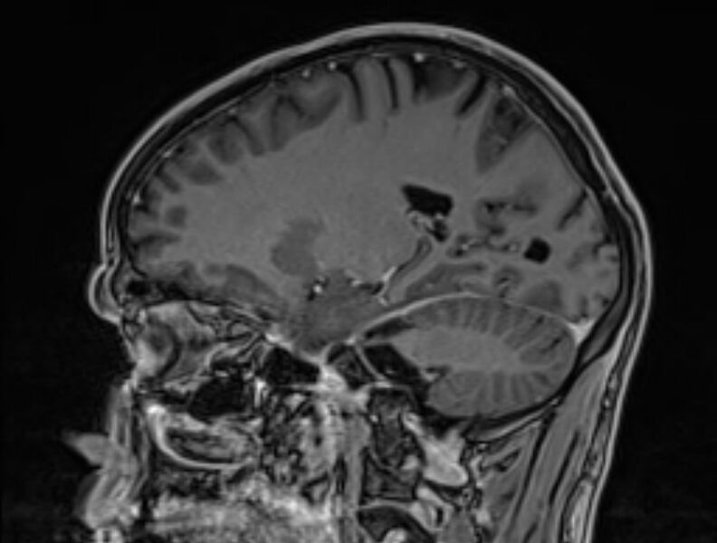File:Cerebral venous thrombosis (Radiopaedia 71207-81504 Sagittal T1 C+ 22).jpg