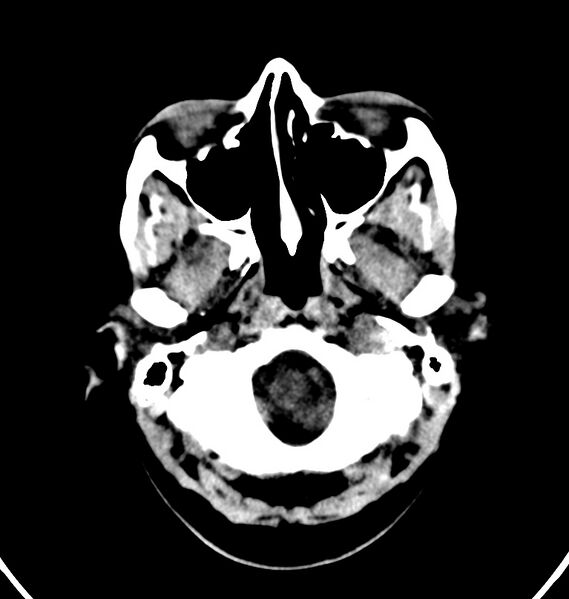 File:Cerebral venous thrombosis - CT only (Radiopaedia 41031-43778 Axial non-contrast 80).jpg