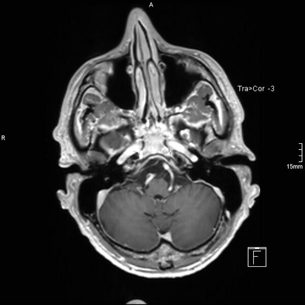 File:Cervical dural CSF leak on MRI and CT treated by blood patch (Radiopaedia 49748-54995 Axial T1 C+ 23).jpg