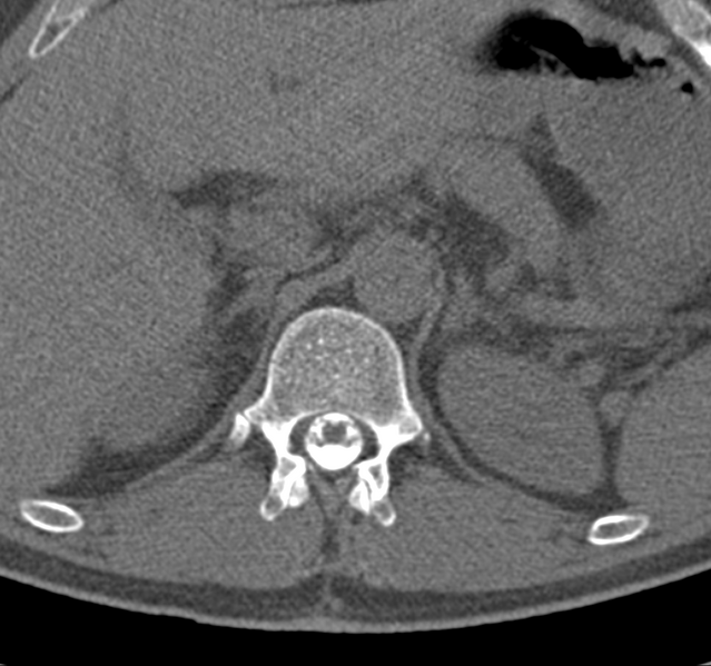 File:Cervical dural CSF leak on MRI and CT treated by blood patch (Radiopaedia 49748-54996 B 83).png