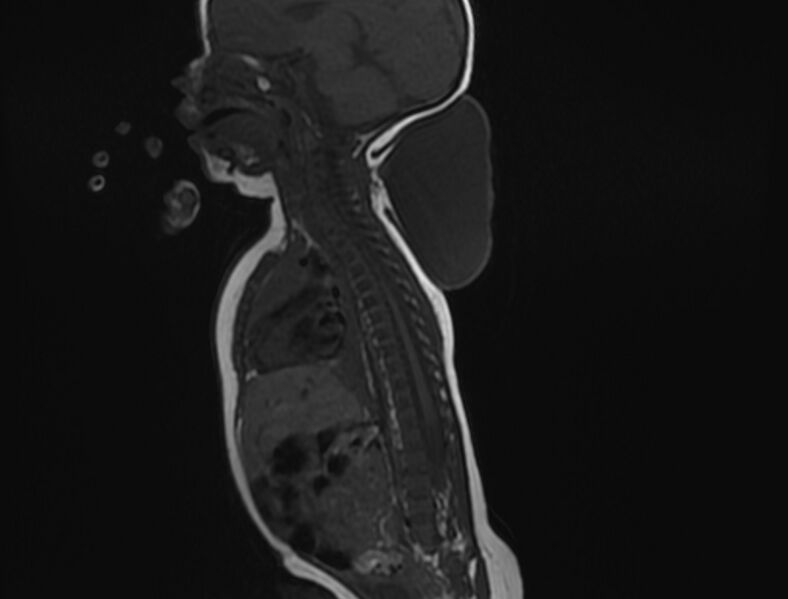 File:Cervical myelomeningocele (Radiopaedia 69569-79479 Sagittal T1 8).jpg