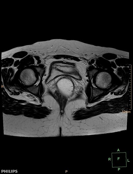 File:Cesarian scar endometriosis (Radiopaedia 68495-78066 Axial T2 19).jpg