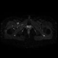 Cesarian section scar endometriosis (Radiopaedia 66520-75799 Axial DWI 25).jpg