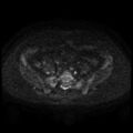 Cesarian section scar endometriosis (Radiopaedia 66520-75799 Axial DWI 53).jpg