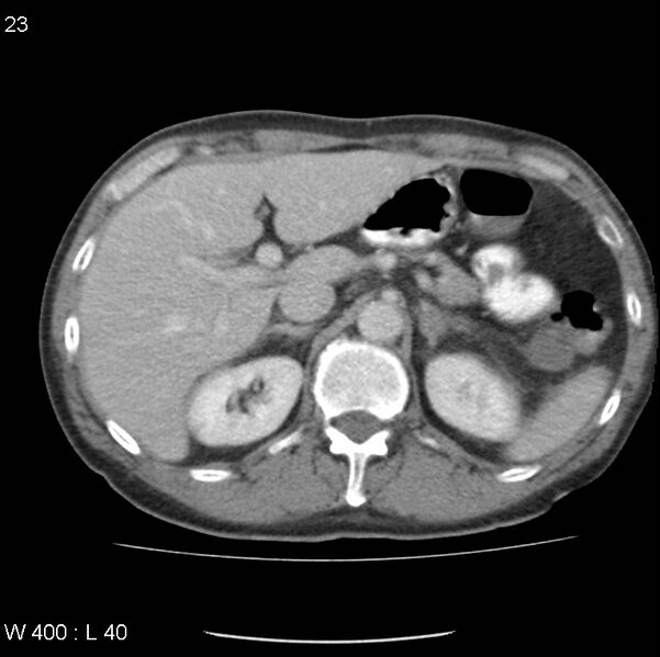 File:Chemotherapy induced enteritis (Radiopaedia 18594-18492 B 16).jpg