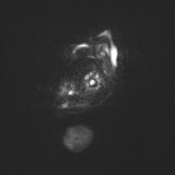 File:Chiari III malformation with occipital encephalocele (Radiopaedia 79446-92559 Axial DWI 23).jpg
