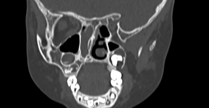 Choanal atresia (Radiopaedia 51295-56972 Coronal bone window 55).jpg