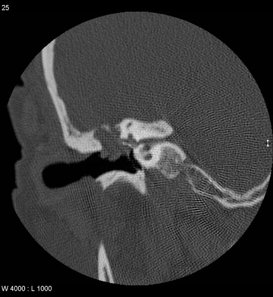 File:Cholesteatoma (Radiopaedia 5467-7197 Coronal bone window 10).jpg