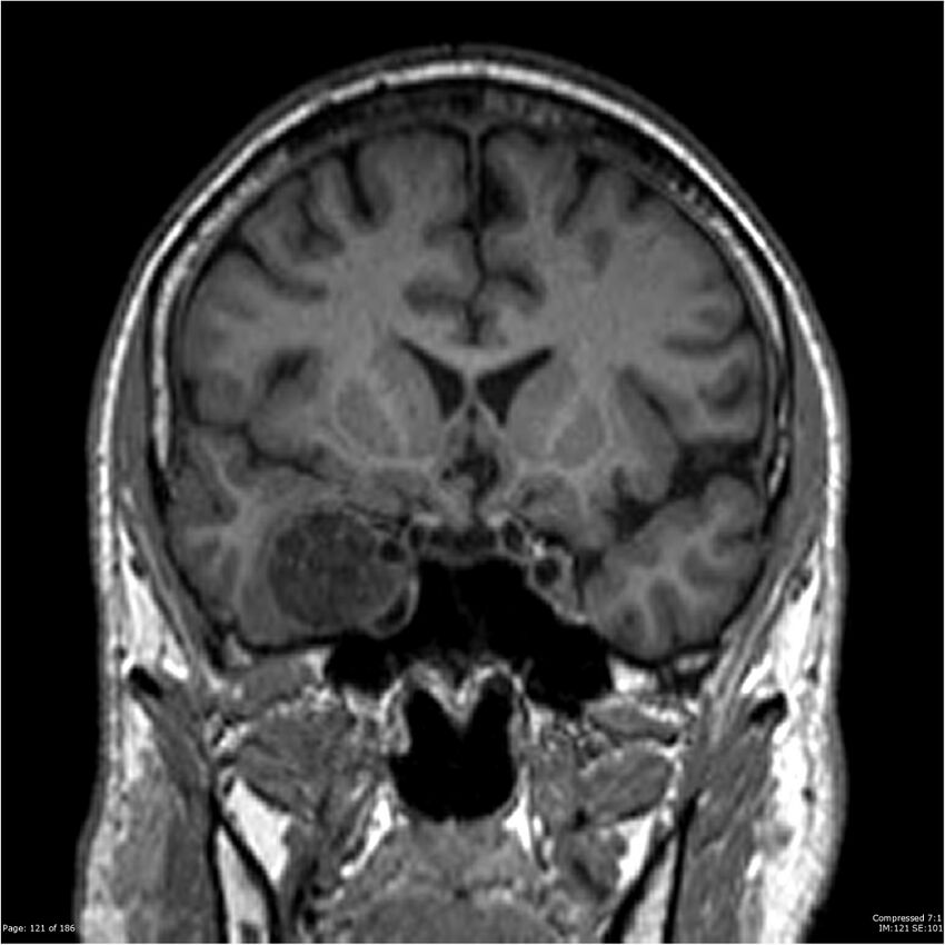 Chondrosarcoma of skull base- grade II (Radiopaedia 40948-43654 Coronal T1 42).jpg