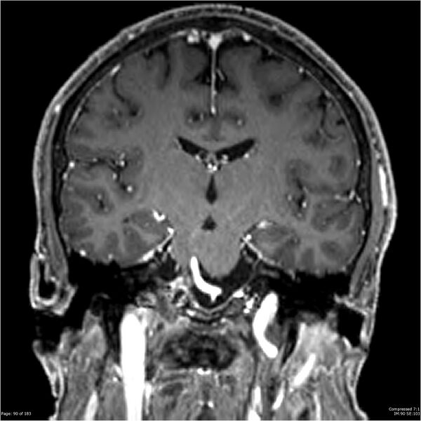 File:Chondrosarcoma of skull base- grade II (Radiopaedia 40948-43654 Coronal T1 C+ 1).jpg