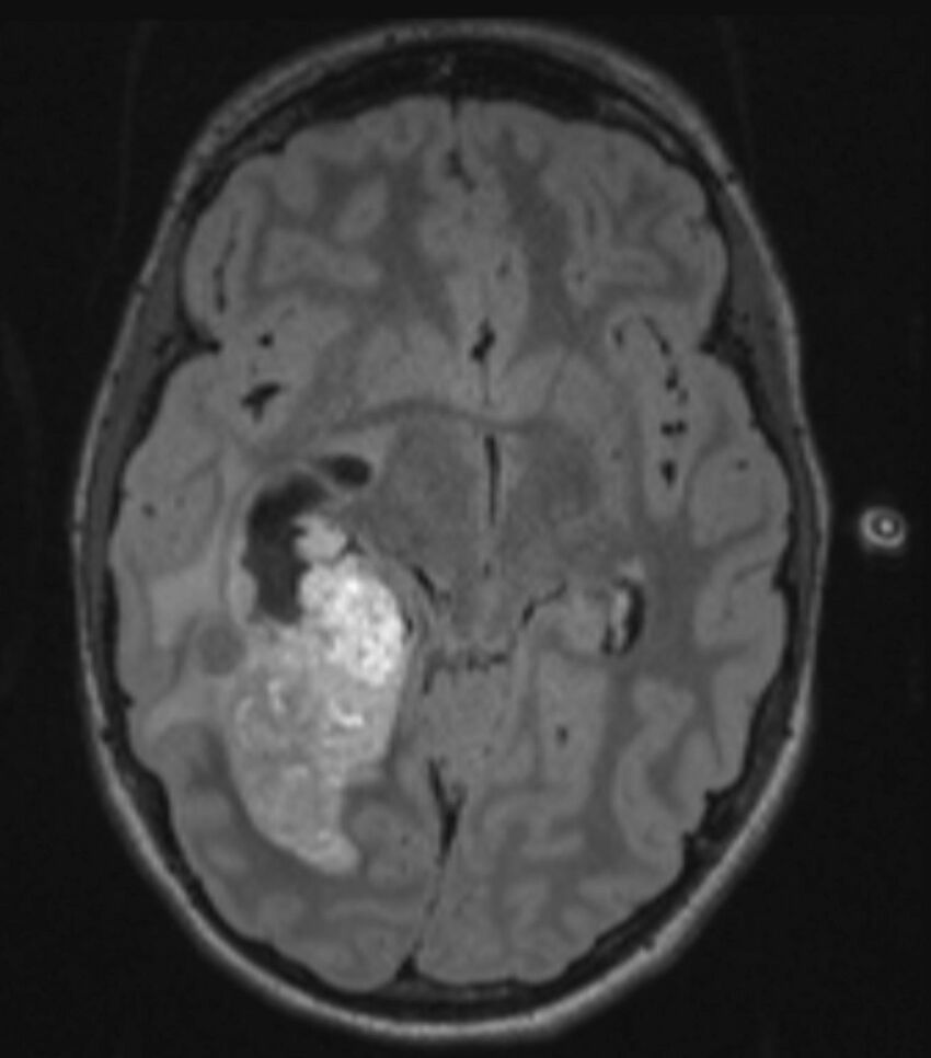 Choroid plexus carcinoma (Radiopaedia 91013-108553 Axial FLAIR C+ 122).jpg
