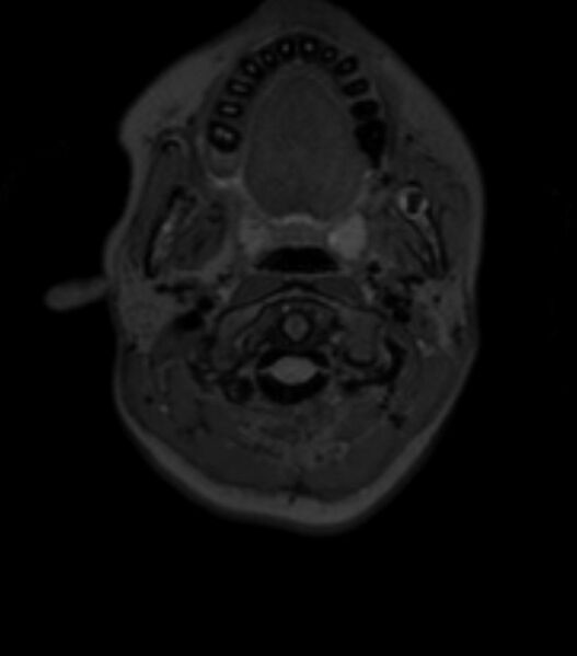 File:Choroid plexus carcinoma (Radiopaedia 91013-108553 Axial T2 fat sat 16).jpg
