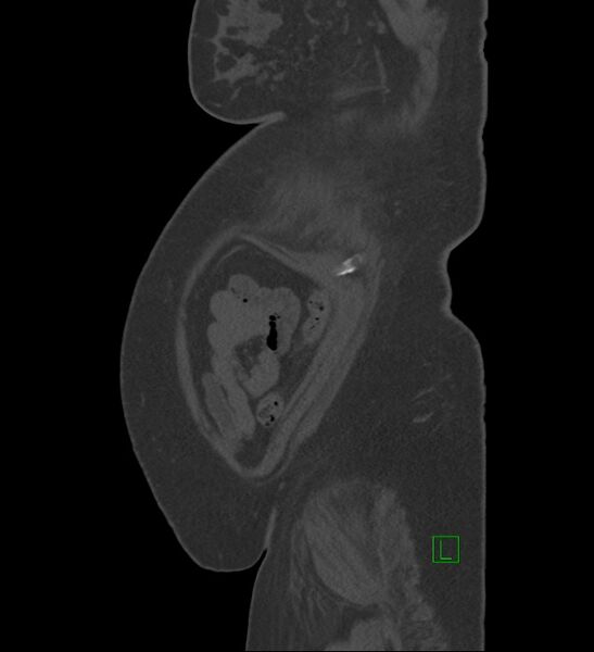 File:Chromophobe renal cell carcinoma (Radiopaedia 84239-99519 Sagittal bone window 6).jpg