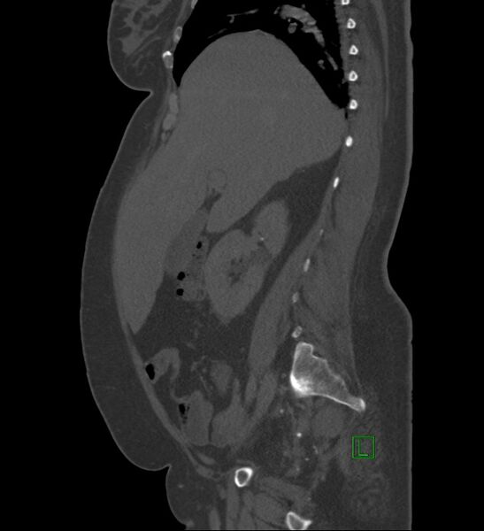 File:Chromophobe renal cell carcinoma (Radiopaedia 84239-99519 Sagittal bone window 71).jpg
